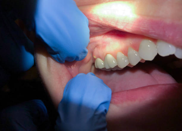 Best Emergency Wisdom Teeth Removal in Weeping Water, NE